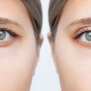 Augenliedkorrektur vorher und nachher