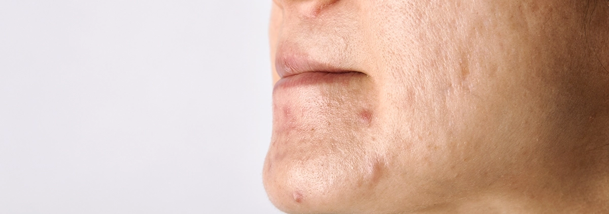 Nahaufnahme eines Gesichts mit Aknenarben